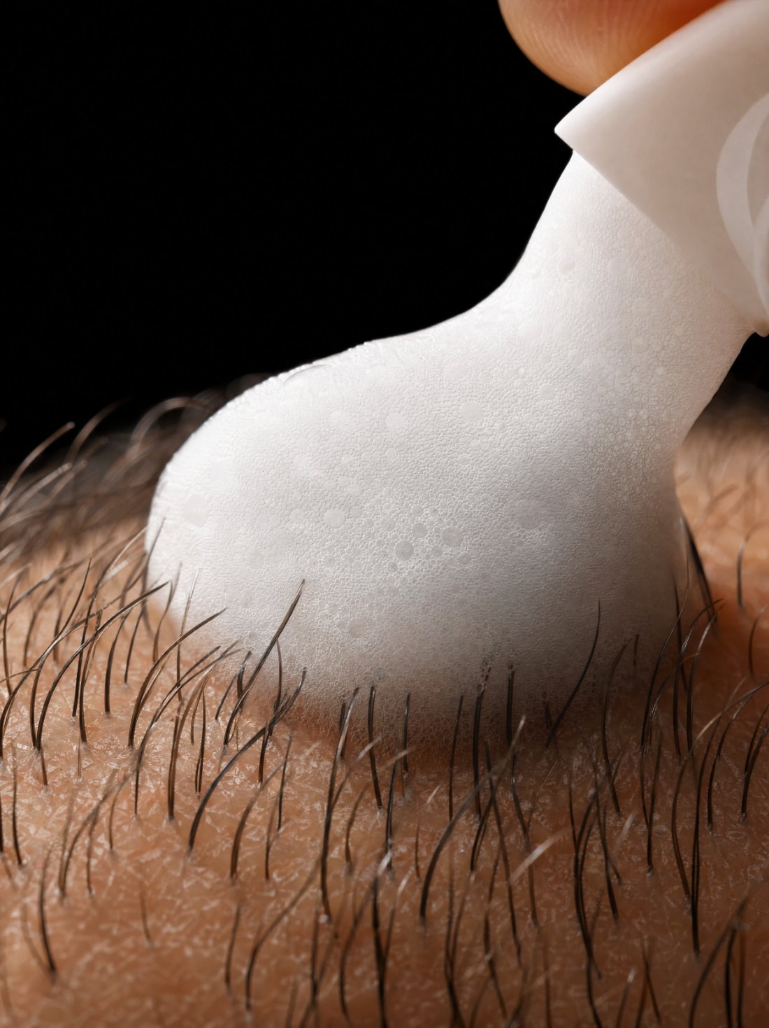 Macro de la espuma drMelas aplicada sobre cuero cabelludo trasplantado